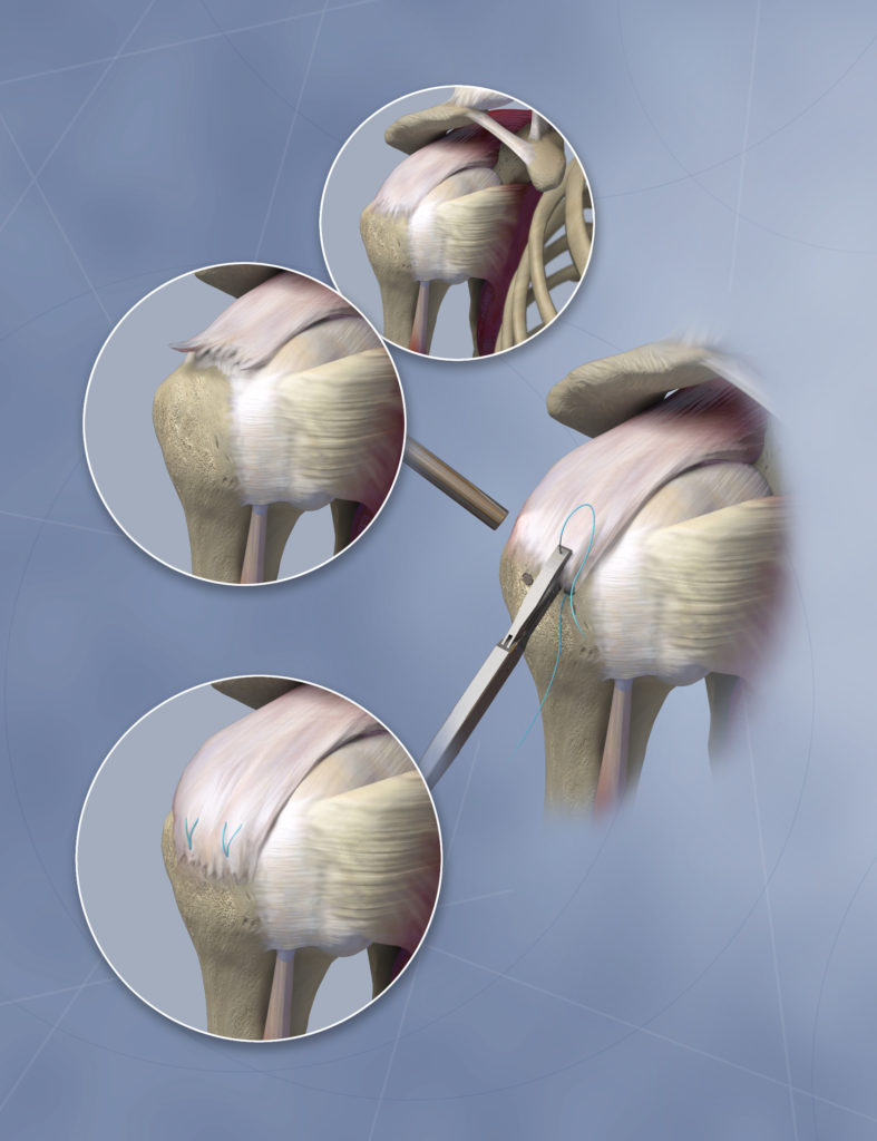 Arthroscopic Shoulder Surgery - A KYU Design