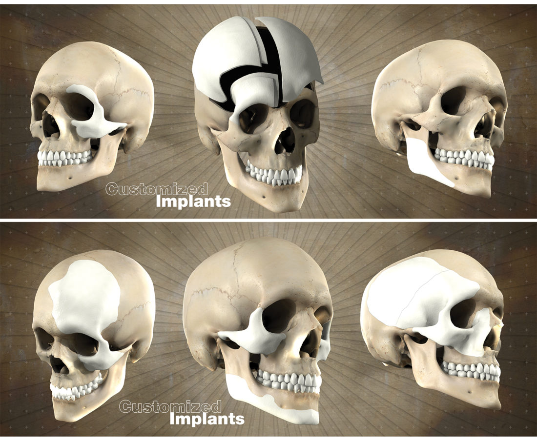 Multiple Customized Skull Implants - A KYU Design